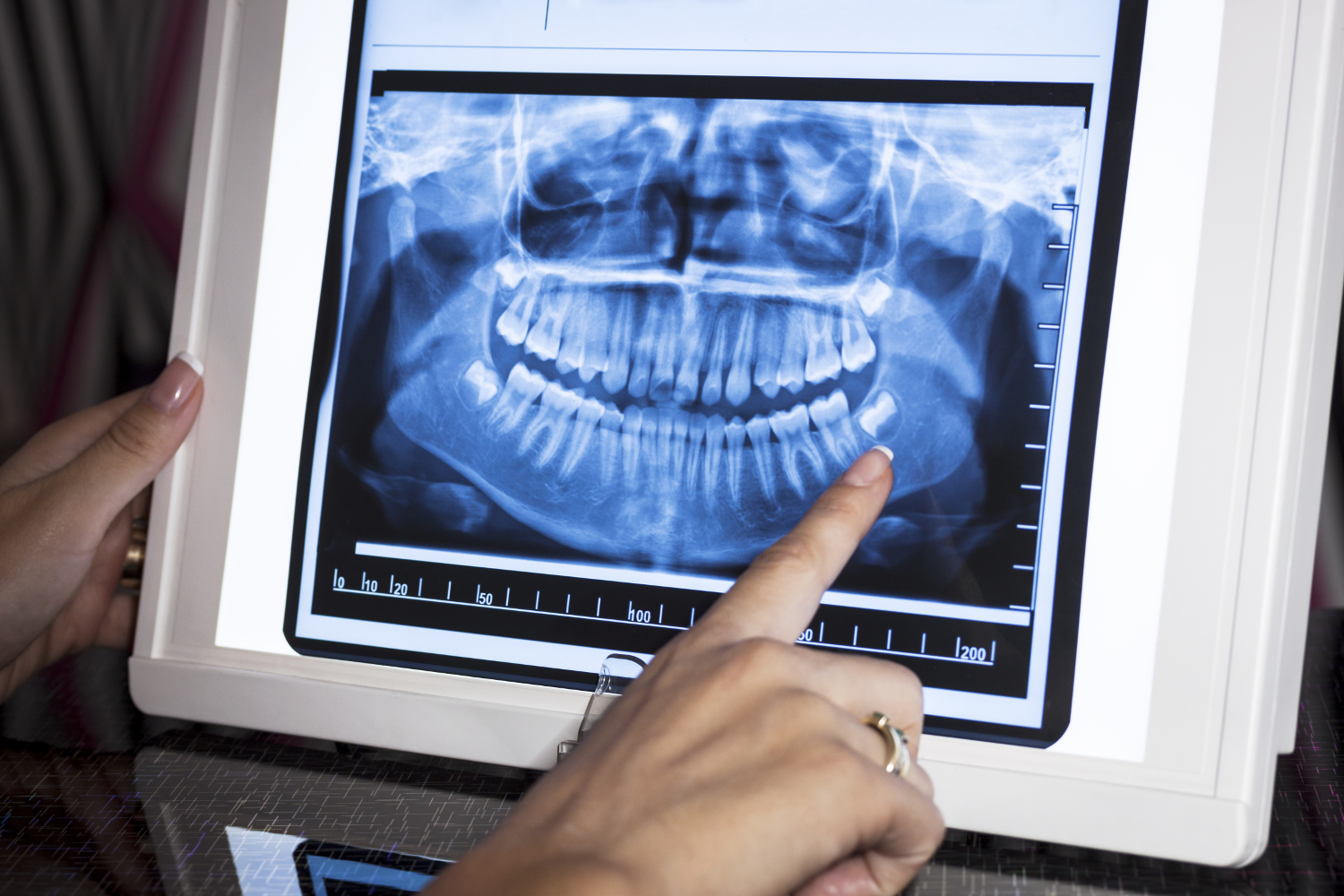 3D dental X-ray scan