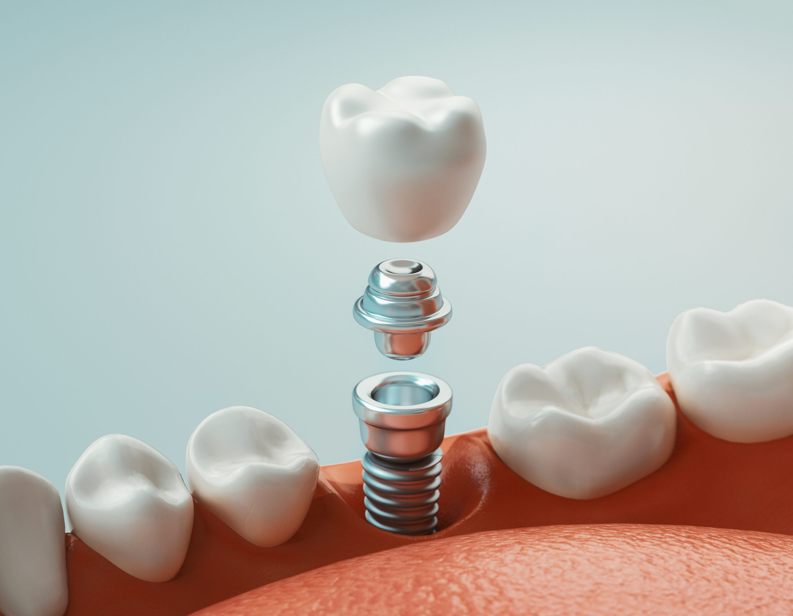 Close-up of a dental implant model